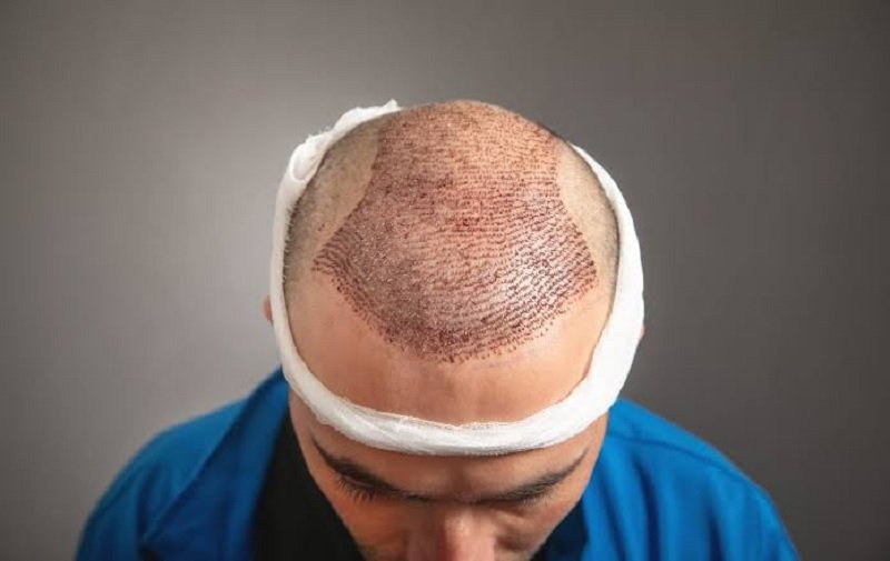 What Is FUE Hair Transplant?