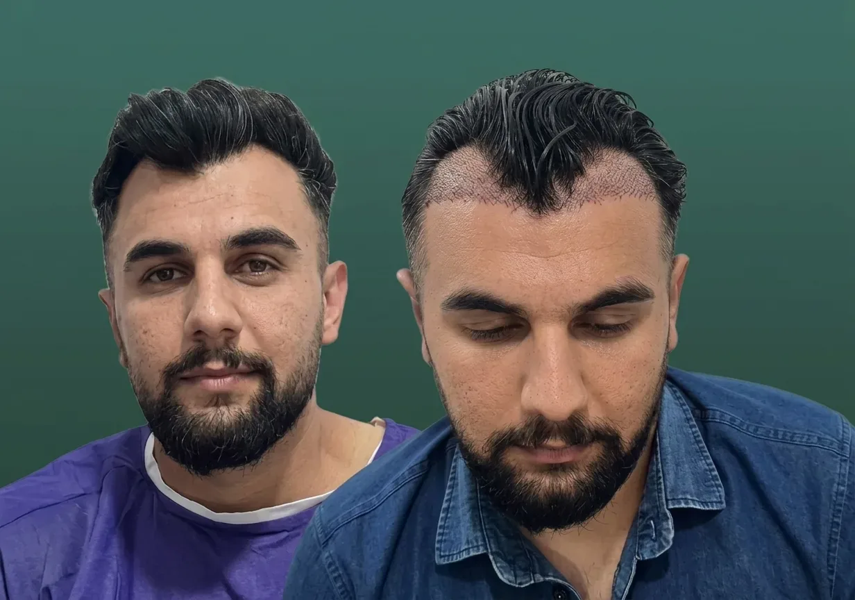 DHI Choi implanter used for unshaven hair transplant at Helia Clinic Dubai