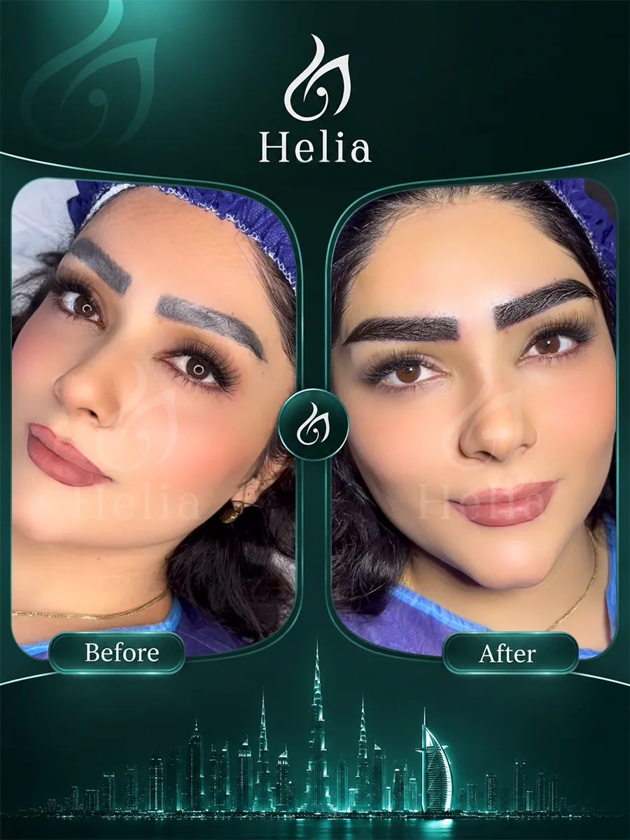 Before and after eyebrow transplant patient result 3 at Helia Clinic Dubai.