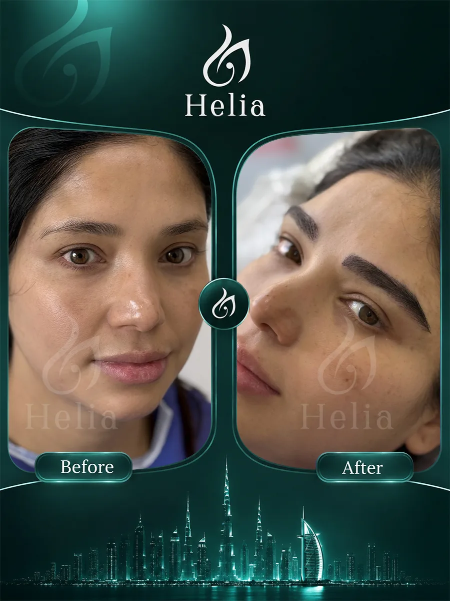 Before and after eyebrow transplant patient result 2 at Helia Clinic Dubai.