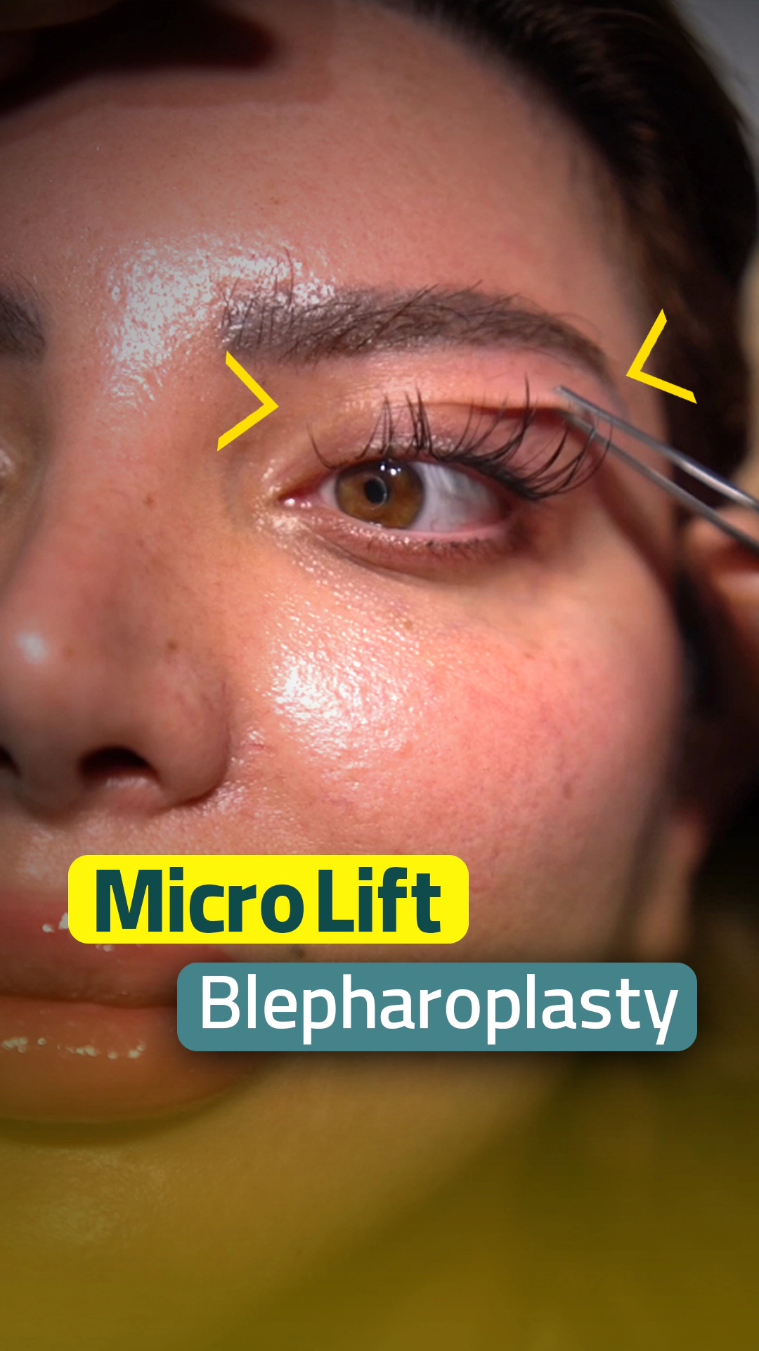 Blepharoplasty before and after result at Helia Clinic Dubai.