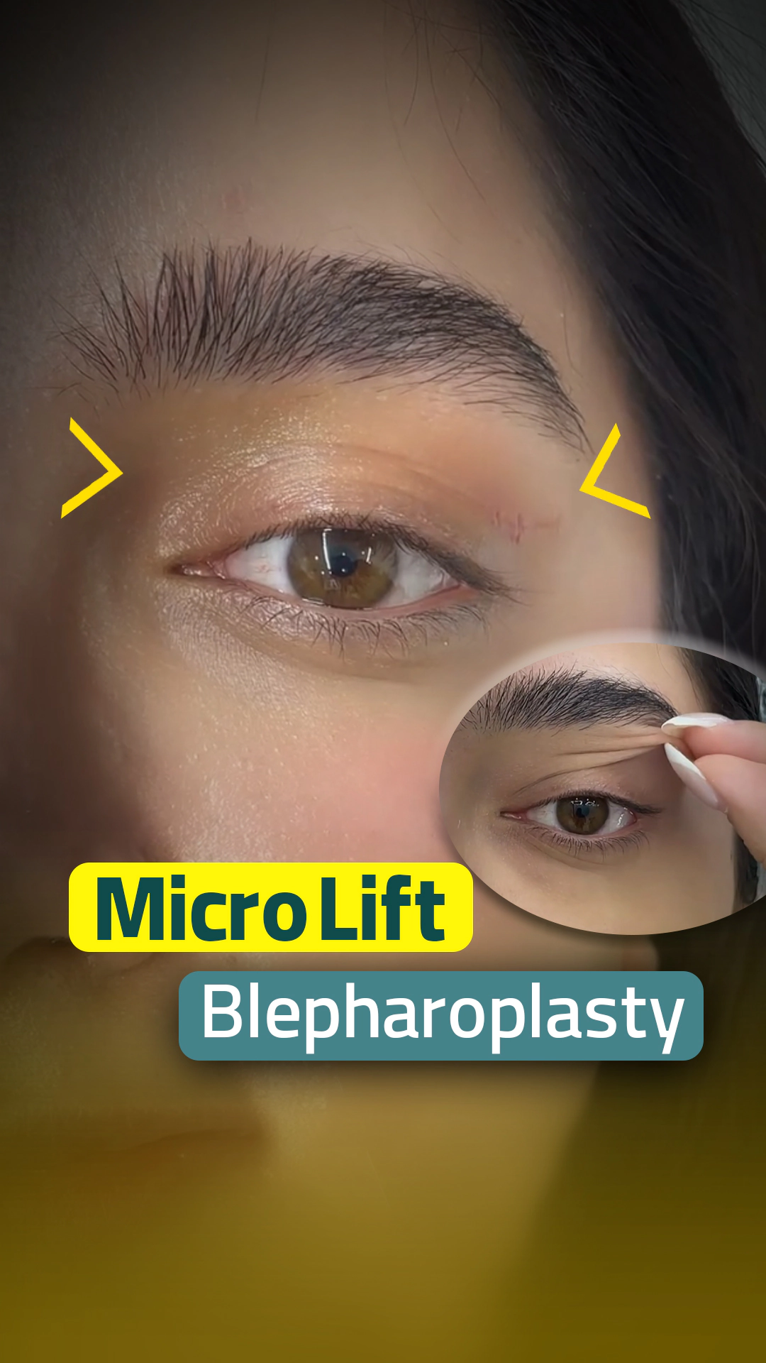 Blepharoplasty before and after comparison at Helia Clinic Dubai.