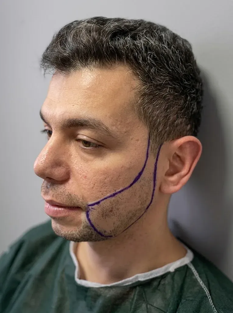 During beard and mustache transplant at Helia Clinic Dubai — immediate post-procedure graft sites.