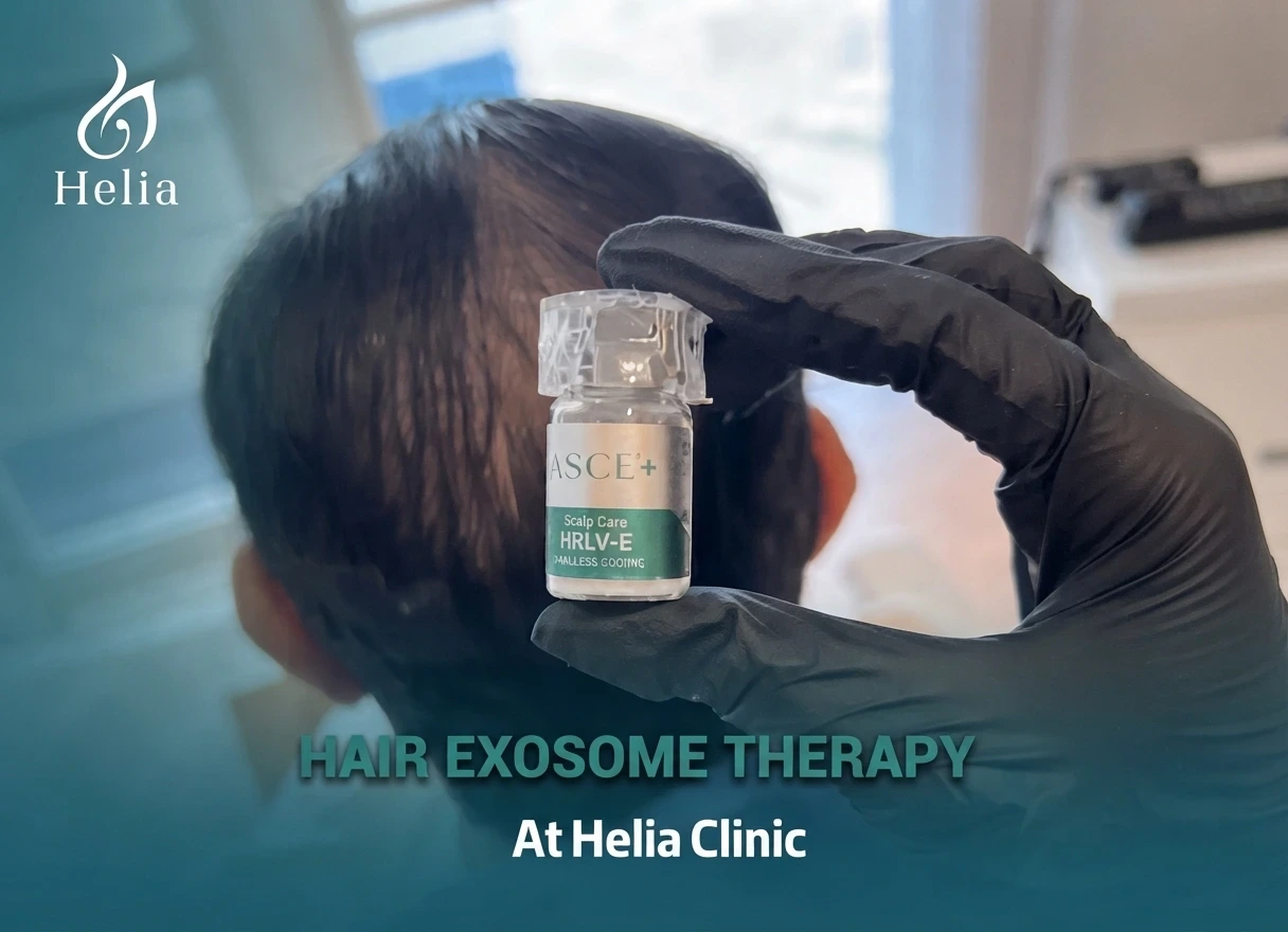 A medical professional holding an ASCE+ HRLV-E exosome vial for hair loss treatment at Helia Clinic.