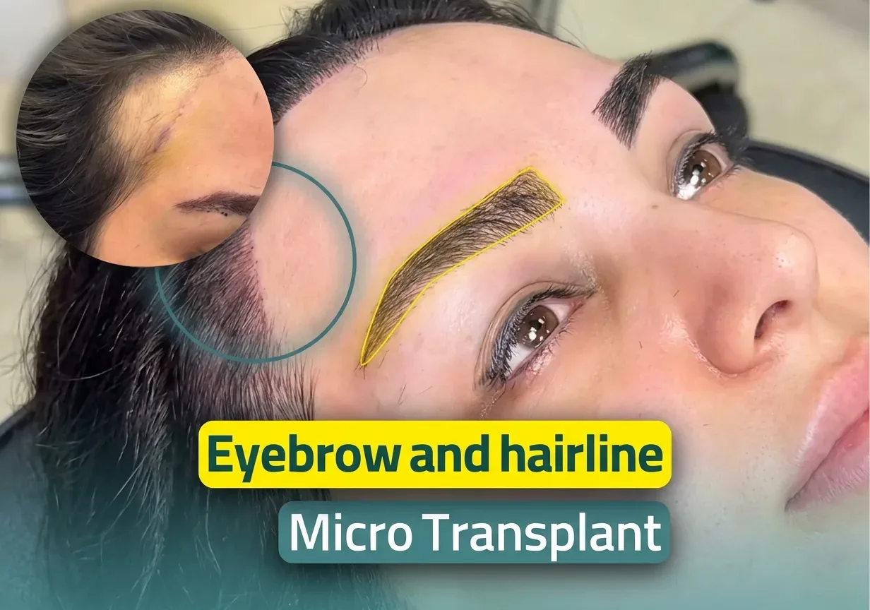 Eyebrow Transplant Dubai