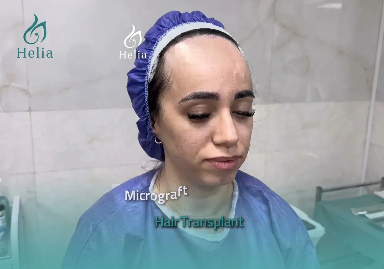 Before female hair transplant at Helia Clinic Dubai — micrograft hairline marking.