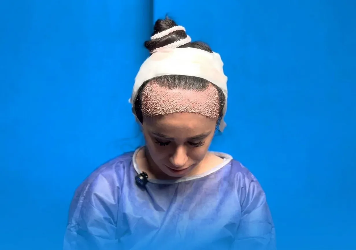 Female hair transplant and restoration at Helia Clinic Dubai