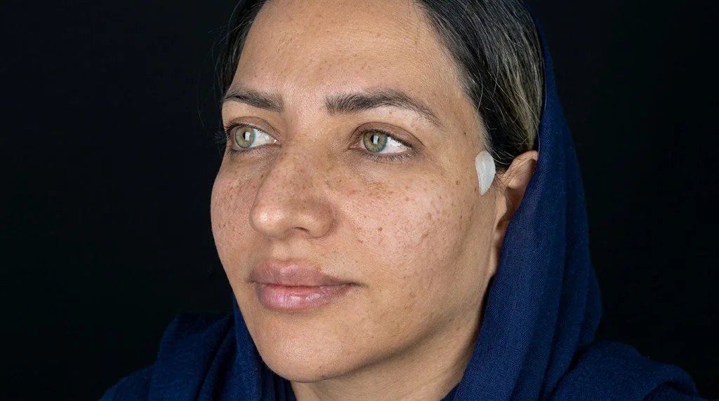Face lift recovery and temple incision care at Helia Clinic Dubai.