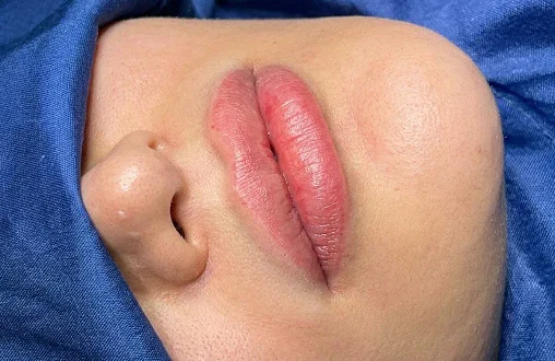 Lip lift perioral aesthetic procedure at Helia Clinic Dubai.