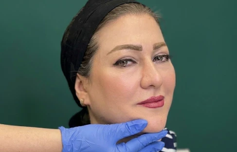 Facial fat transfer procedure planning at Helia Clinic Dubai.