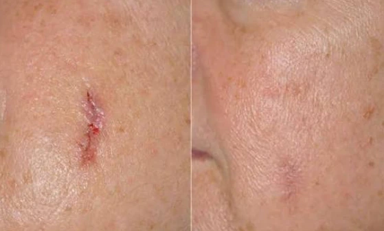 Facial scar revision surgery before and after at Helia Clinic Dubai.