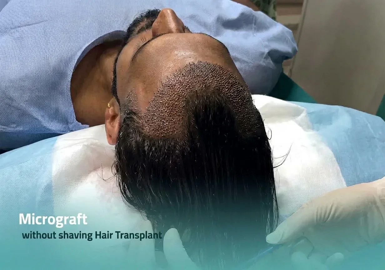 Unshaven no-shave hair transplant in Dubai at Helia Clinic