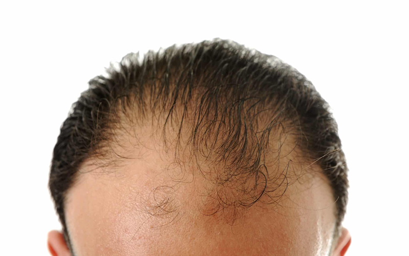 Hair Transplant Expectations: What’s Real and What’s Not?