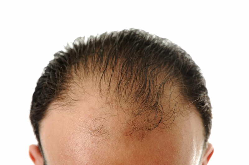 Hair Transplant Expectations: What’s Real and What’s Not?