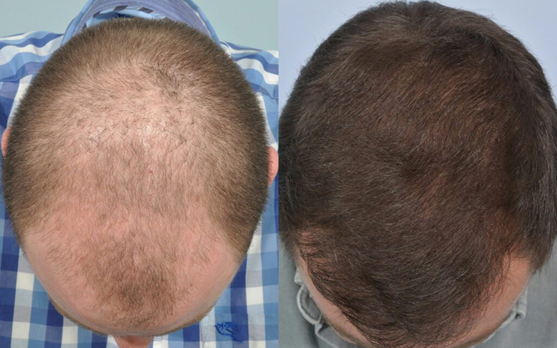 Do Hair Transplants Last Forever? Which Method Lasts Longest?