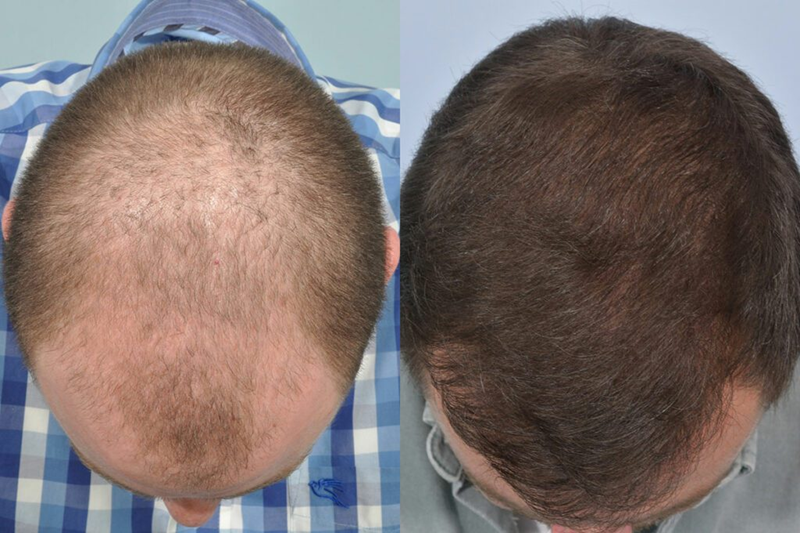 Do Hair Transplants Last Forever? Which Method Lasts Longest?
