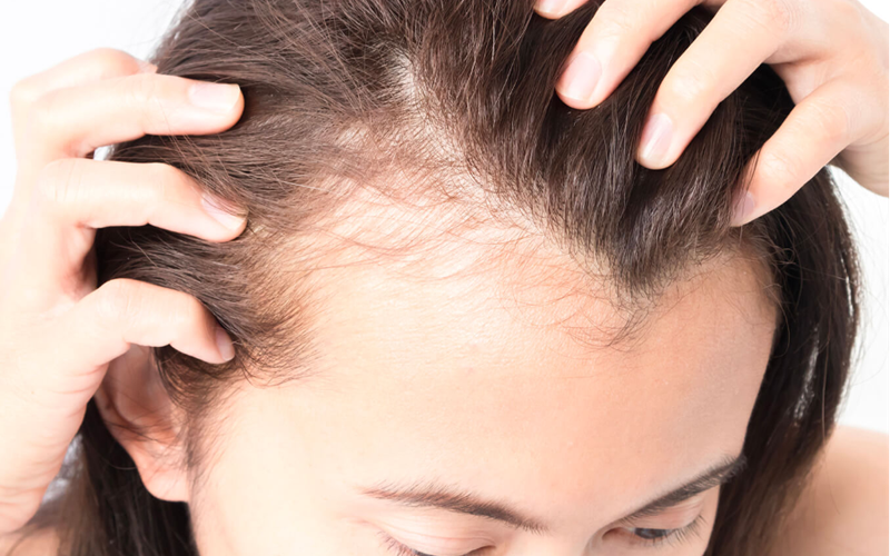 Female Hair Loss: Causes, Signs & Treatment Options