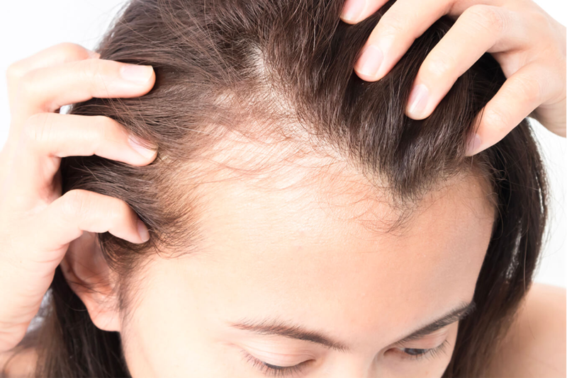 Female Hair Loss: Causes, Signs & Treatment Options