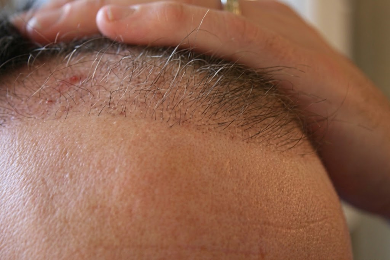 Natural-looking hair transplant results