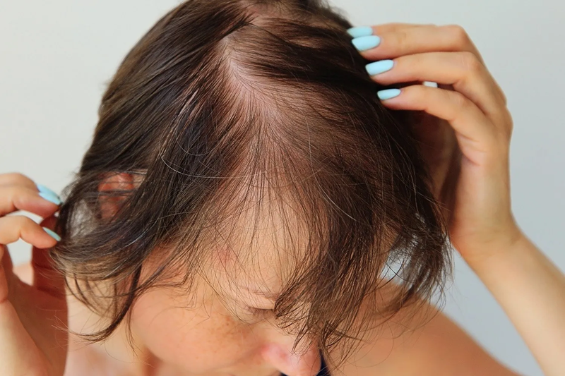 Hair transplant for women