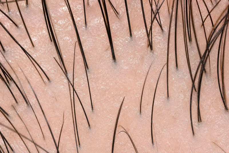 Vertex hair transplant crown restoration
