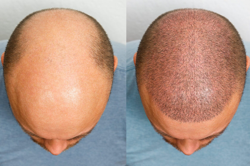 Hair transplant before and after