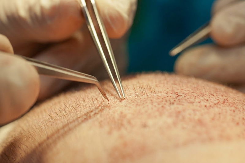 Crown hair transplant graft placement technique