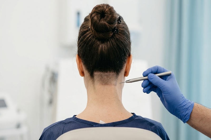 FUE Hair Transplant