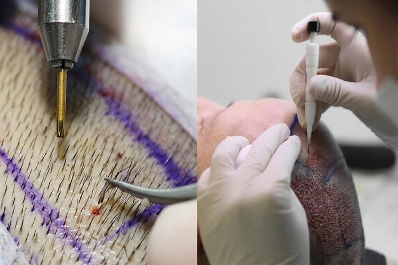 FUE and DHI hair transplant techniques