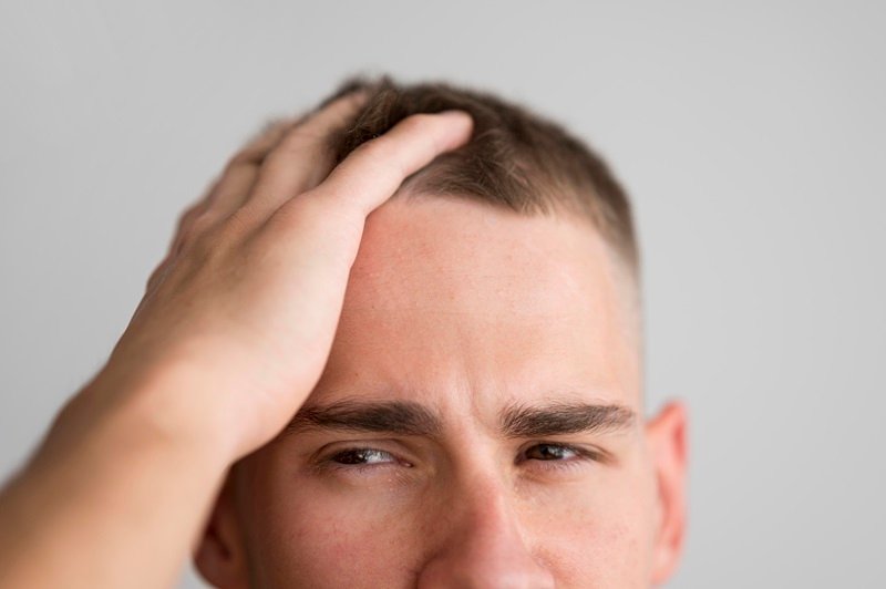 Male pattern hair loss with thinning at the crown of the scalp
