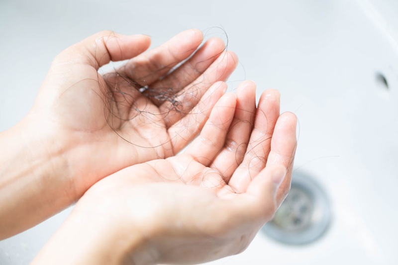 Excessive hair shedding associated with telogen effluvium
