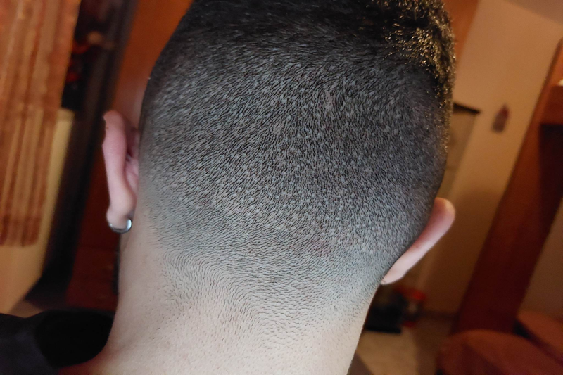 Buzz Cut Donor Area After Hair Transplant