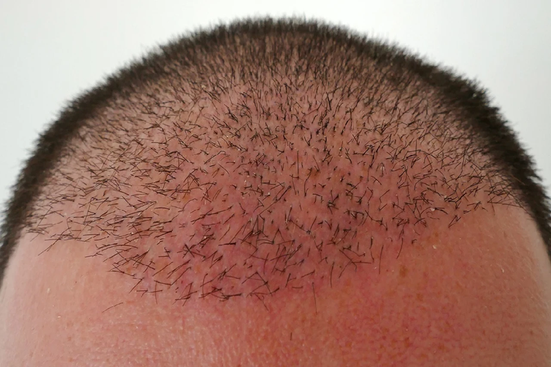 Hair plugs with an unnatural hairline