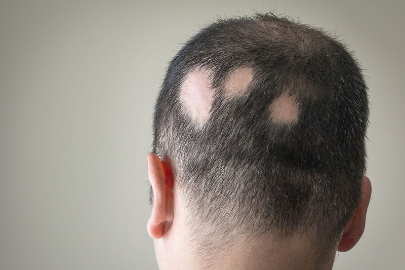 Round bald patch on the scalp caused by alopecia areata