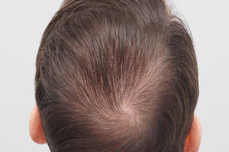 Natural-looking crown hair transplant results