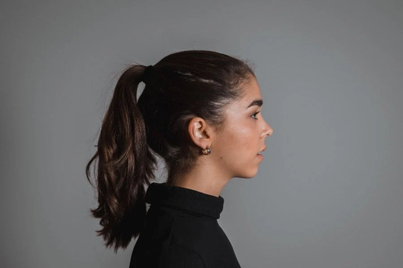 Tight ponytail causing hair tension around the hairline in traction alopecia