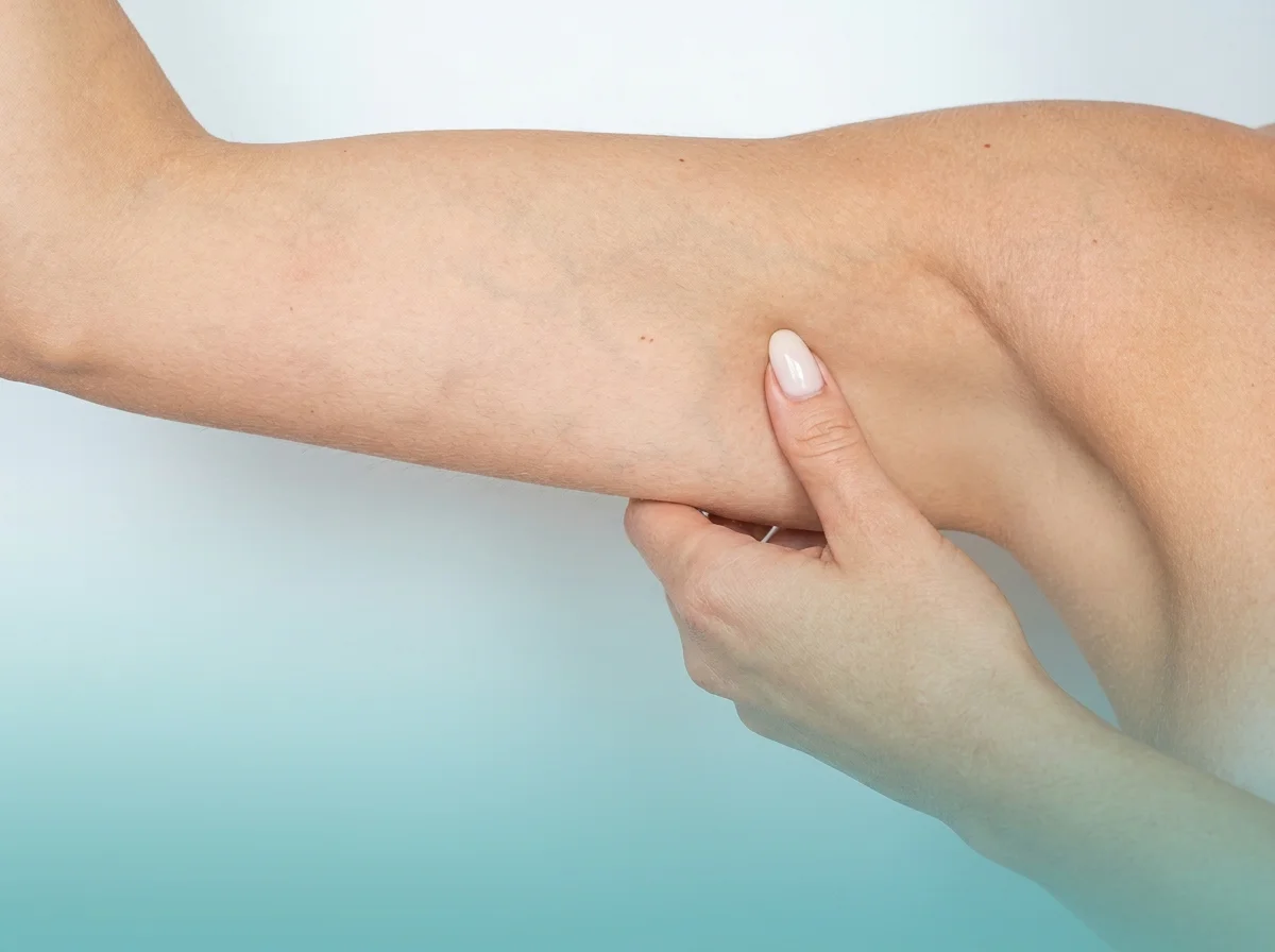 Before and after arm lift results at Helia Clinic Dubai, showing tighter upper-arm contour after brachioplasty