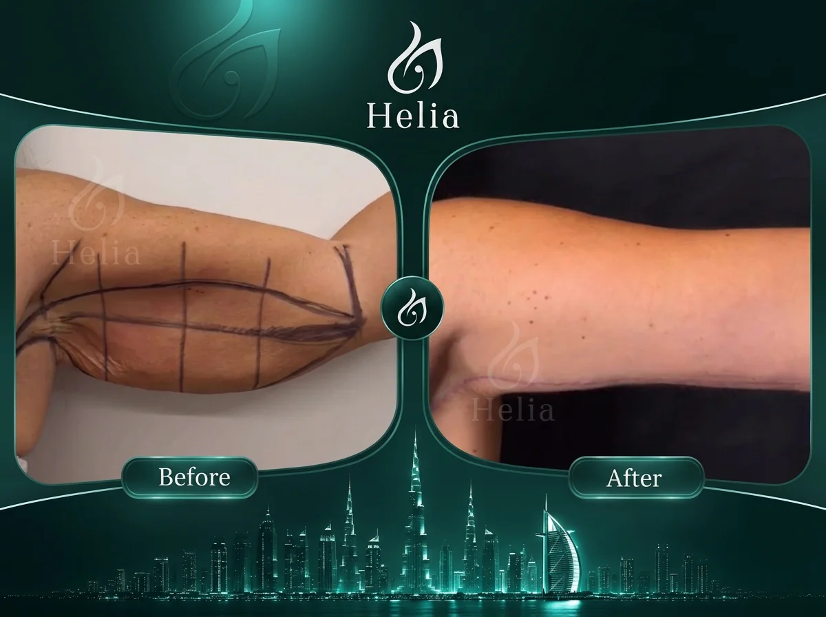 Close-up of loose upper-arm skin being pinched, showing skin laxity addressed by arm lift surgery at Helia Clinic Dubai