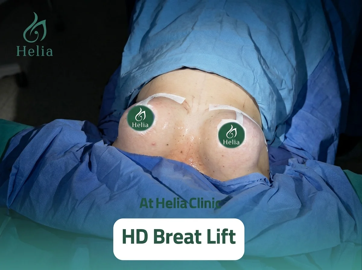 Post-operative results of an HD Breast Lift surgery at Helia Clinic Dubai showing surgical markings and initial recovery.