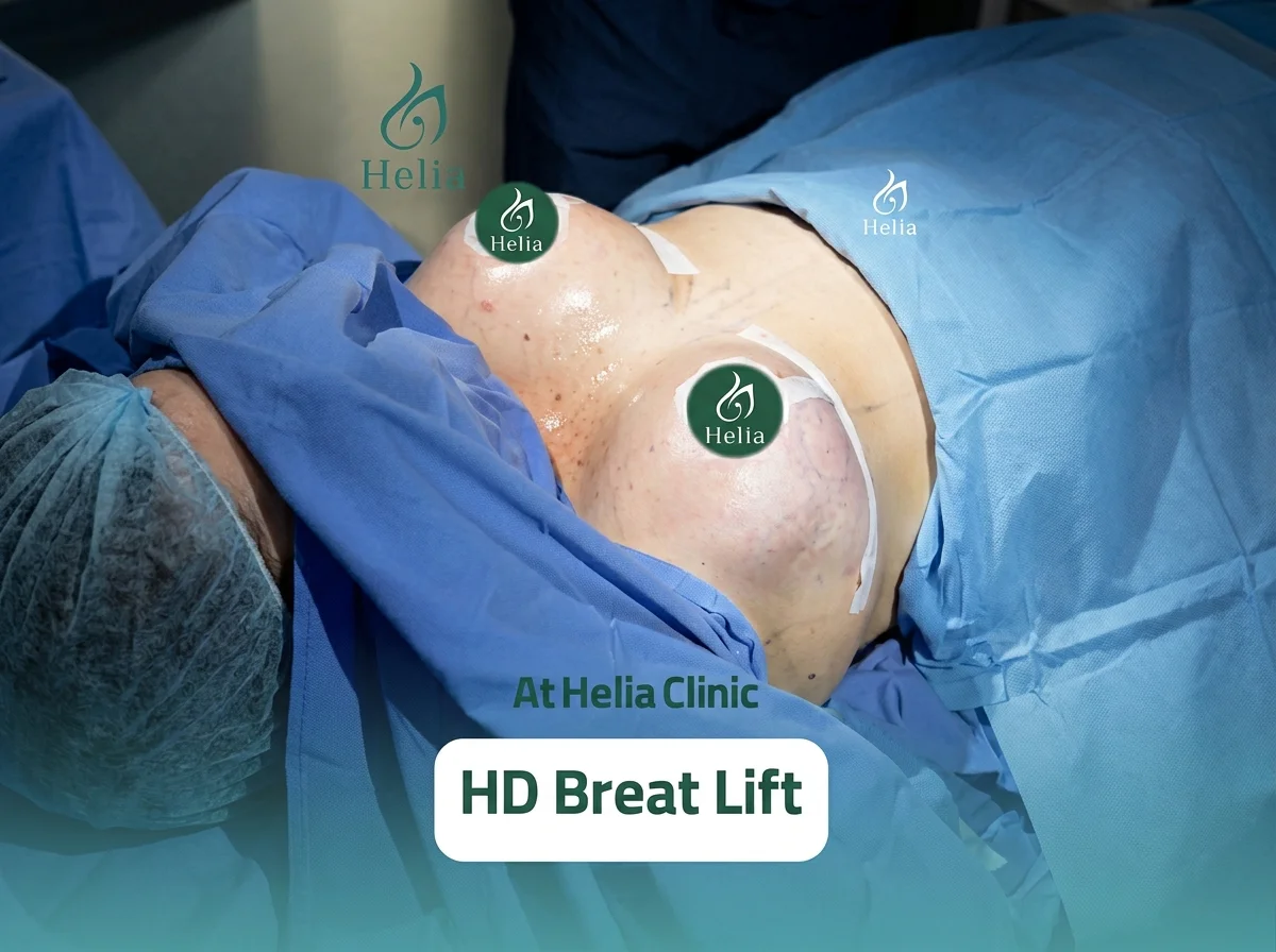 Clinical view of an HD Breast Lift surgery result at Helia Clinic Dubai, showing the lifted chest area with surgical markings in a sterile operating room.