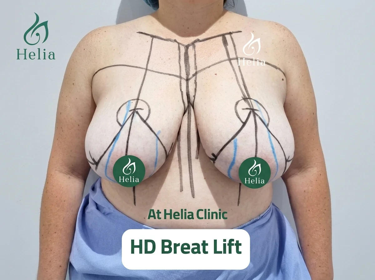 Clinical photograph showing preoperative surgical markings and planning for a breast lift procedure at Helia Clinic Dubai.