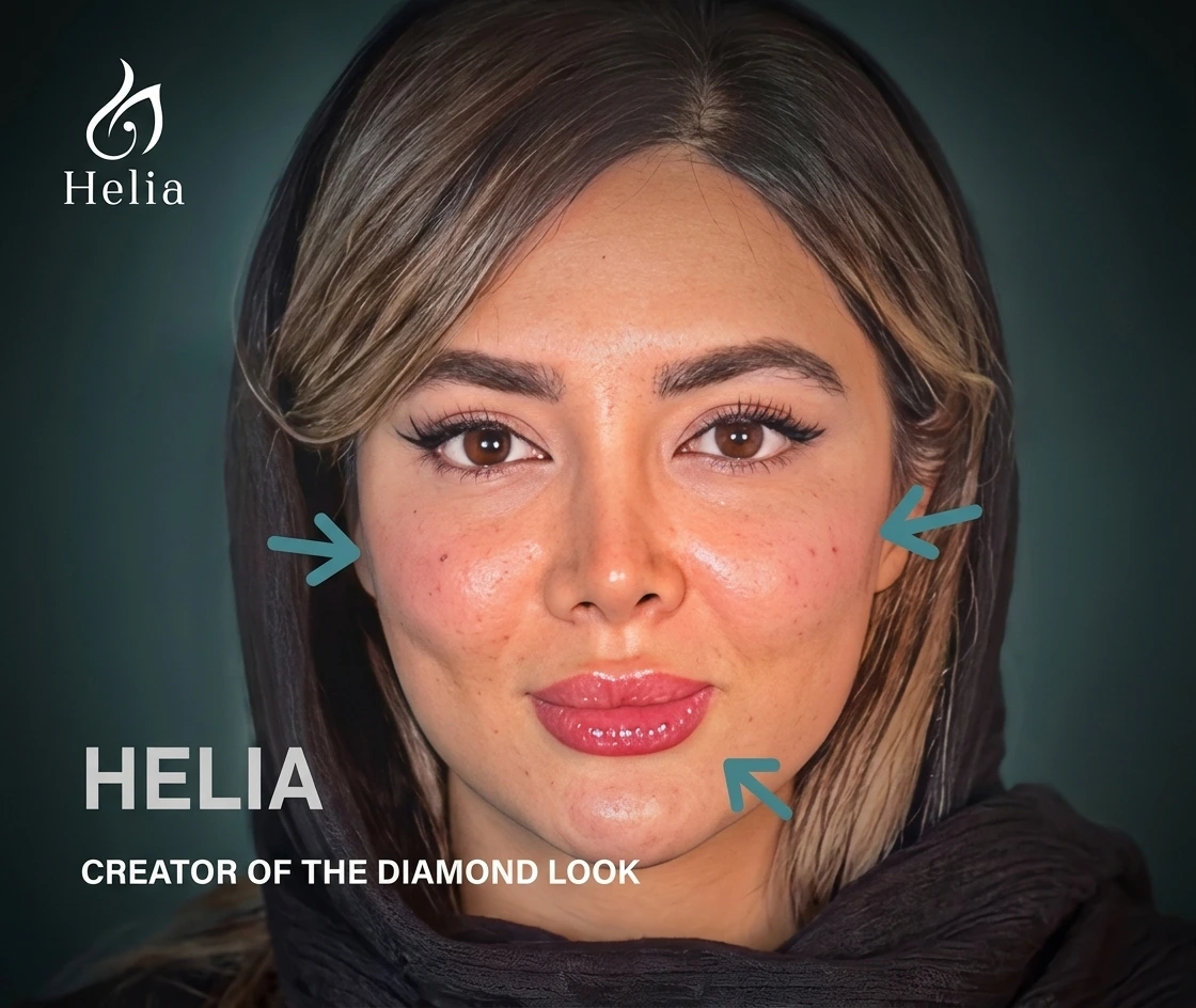 Close-up of a woman with Helia branding illustrating diamond face contouring treatment zones with teal arrows.