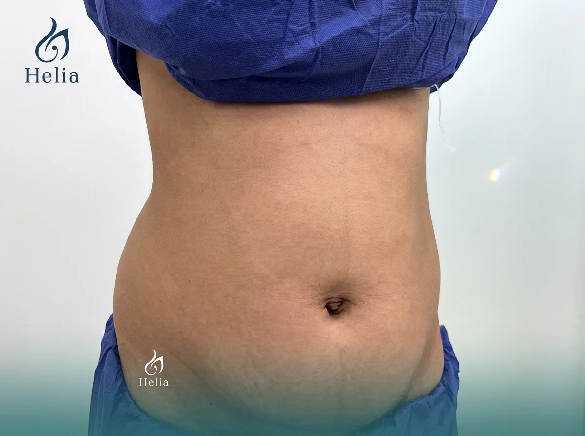 Front view of a patient's abdomen before high-definition liposuction at Helia Clinic, showing the target area for body contouring.
