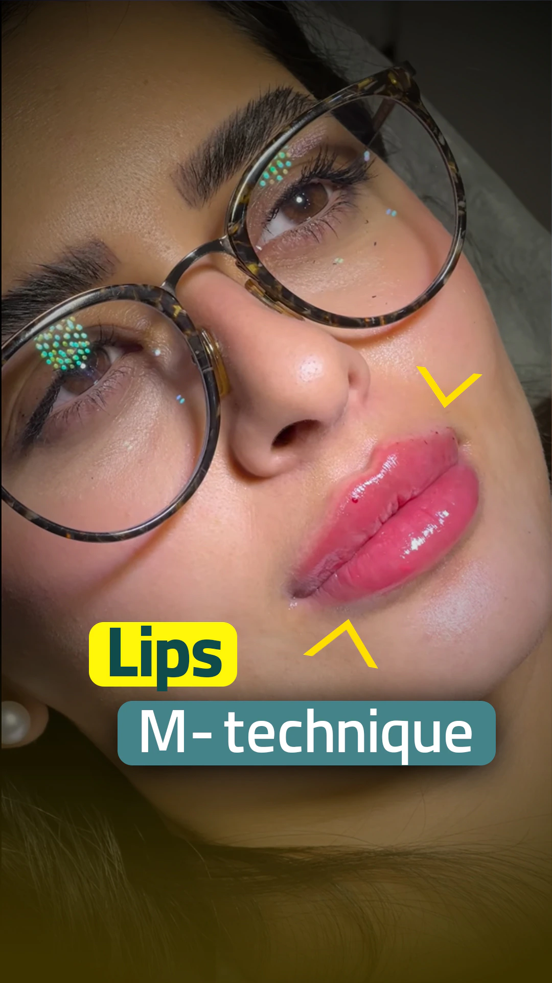 نمای نزدیک از لب‌های صورتی براق چاق پس از پرکننده لب با تکنیک M، که لبه‌های کمان و لب کوپید را در کلینیک هیلیا تهران برجسته می‌کند.